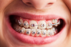 les-7-principaux-types-d-appareils-orthodontiques-dentiste-marseille